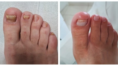 Pé antes e depois do tratamento de fungos na unha
