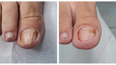Dedão antes e depois do tratamento de unha encravada