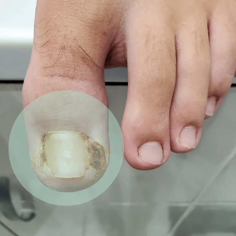 Unha encravada no dedão do pé